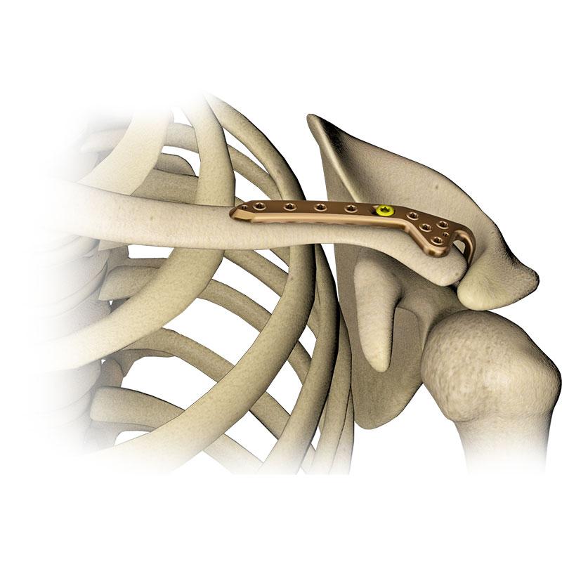 Пластина ключична з гачком 5.0ChLP